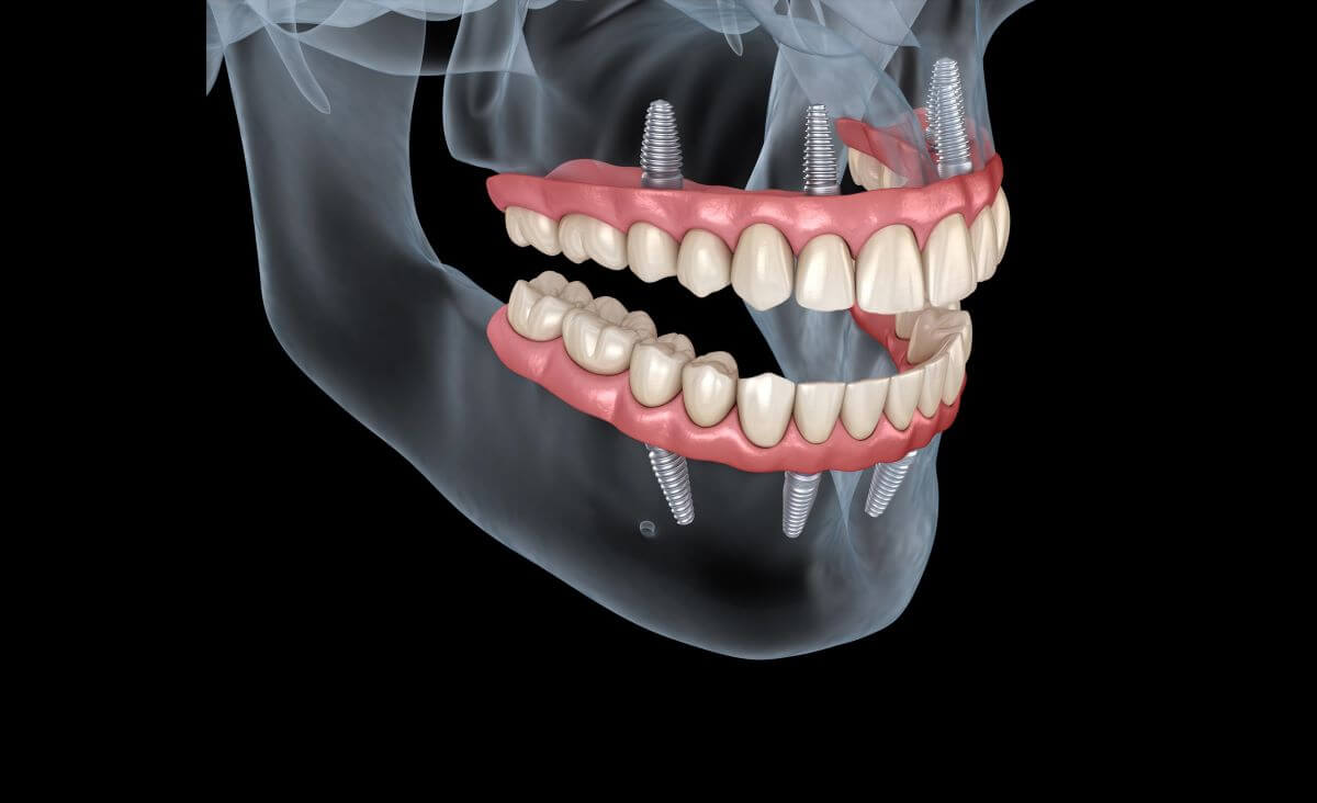 Visit the Dentures Before/After Gallery